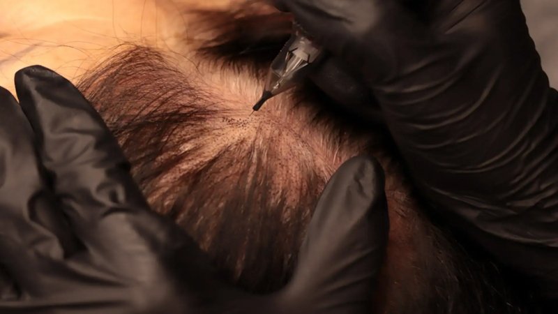 Scalp Micropigmentation in Sydney